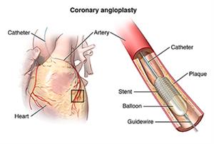 Heart with catheter placed in artery, with detail of balloon and stent in artery for coronary angioplasty.